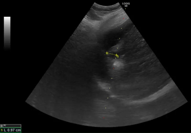 ▲超音波導引下的電燒治療，黃色標記處為肝臟腫瘤，周圍白色為氣化範圍。（圖／台北慈院提供）
