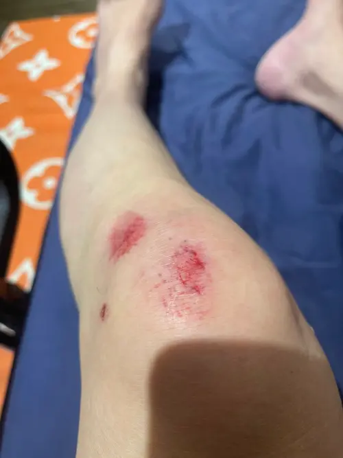 ▲孫德榮曬出自己受傷的照片。（圖／孫腫來了 臉書）