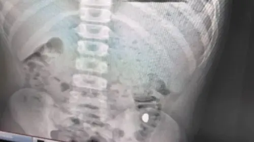 11歲童誤吞金豆！母天天叮囑「不准在外大號」　5天後就醫終排出
