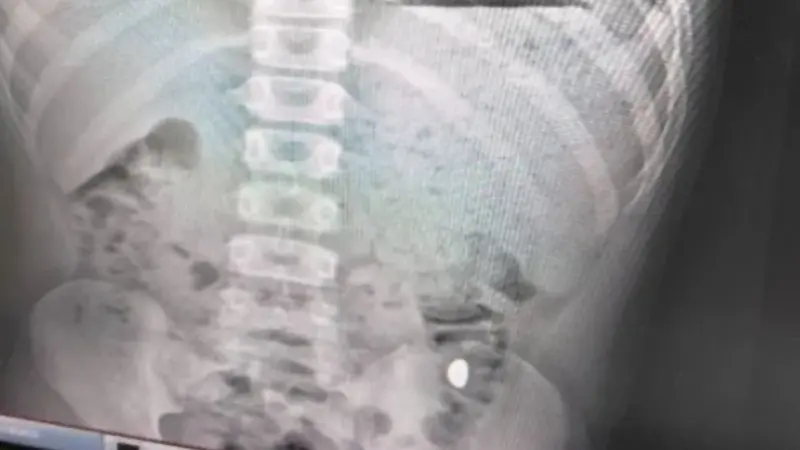 ▲中國江蘇1名11歲男童，不慎將10g小金豆吞下肚，母親為了怕損失，禁止他在外頭大號，等了5天見金豆沒隨排泄物排出，才帶兒子就醫。（圖／翻攝自微博）