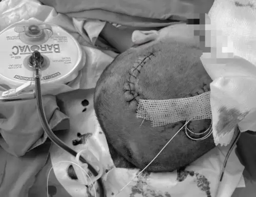 3歲童從上鋪摔落「顱內嚴重出血」！醫緊急開顱搶命
