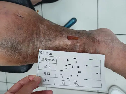 ▲男子腳踝傷口潰爛10多年，醫師檢查發現，是靜脈瓣膜閉鎖不全所導致。（圖／員榮醫院提供）