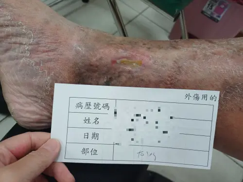 男傷口潰爛10多年！醫揪出「靜脈瓣膜閉鎖不全」　6症狀小心

