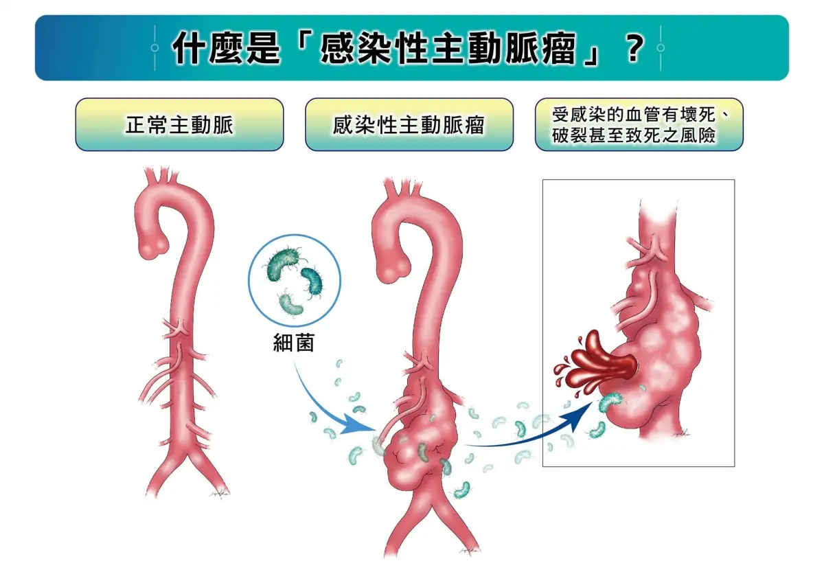 ▲感染性主動脈瘤是由病原體入侵主動脈，導致血管壁壞死、破裂的罕見疾病，若未即時治療，死亡風險極高。（圖／長庚醫院提供）