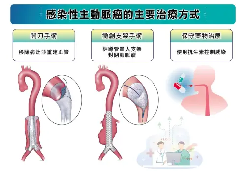 ▲感染性主動脈瘤3種主要治療方式包括開刀手術、血管內微創修補以及保守藥物治療，不同方法各有適用情況。（圖／長庚醫院提供）