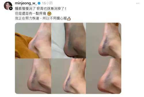 ▲南珉貞腳踝90度外翻重摔傷勢曝！腳背驚見大片淤青　粉絲超心疼。（圖／南珉貞Threads@minjeong_w_）