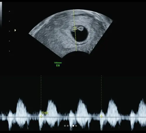 ▲鐵牛今日在IG發出超音波圖，興奮喊：「謝謝你來當我們的第三位寶貝」。（圖／翻攝自IG ironbullim）