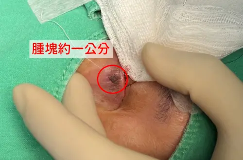 ▲醫師提到，腫塊難以用肉眼立即判斷良性或惡性，一旦出現出血、疼痛或視線遮蔽等症狀，都應及早就醫處理。（圖／中醫大新竹附醫提供）