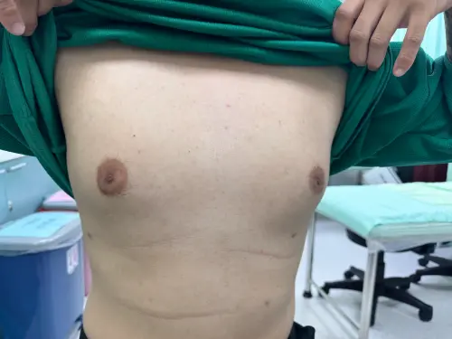 ▲台中一名30歲的男性國中青春期時，發現自己胸部異常隆起，外觀宛如女性胸型，手術順利解決「男性女乳症」。（圖／烏日林新醫院提供）