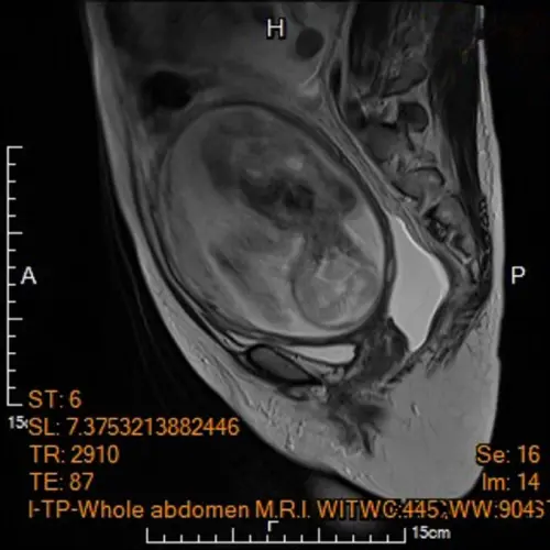 ▲電腦斷層顯示子宮內胎兒。（圖／馬偕紀念醫院）
