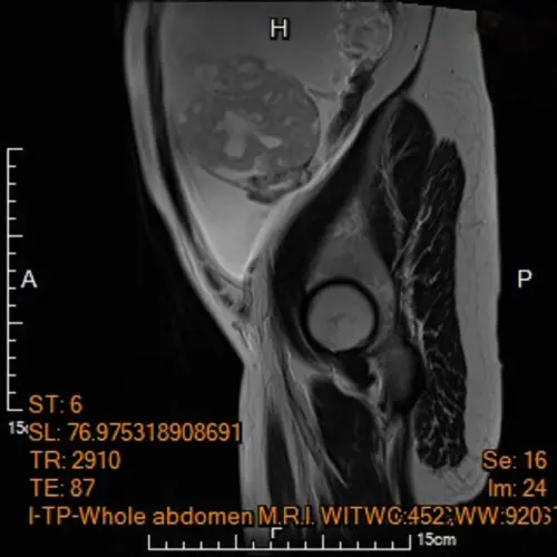 ▲孕婦電腦斷層呈現腹水與卵巢腫瘤（圖／馬偕紀念醫院）