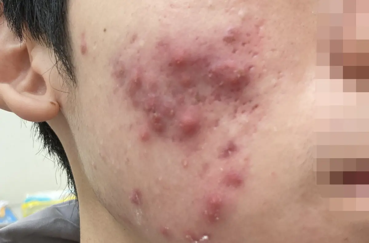 面對青春痘別輕忽 醫提醒把握治療黃金期