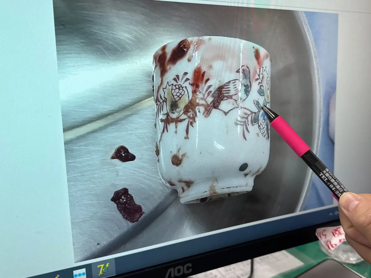 男不能說的秘密 肛門卡杯子 醫看：太扯了