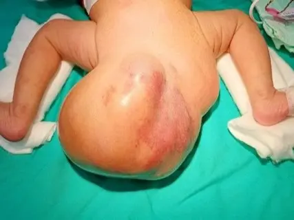 女嬰出生臀部長「16公分大球」！醫揭尾骶骨畸胎瘤 10周激大4倍