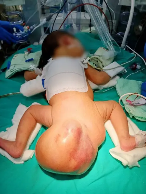 ▲女嬰出生時臀部長了「16公分大球」，經檢查為罕見的先天性尾骶骨畸胎瘤。（圖／澄清醫院中港分院ck.ccgh.com.tw）