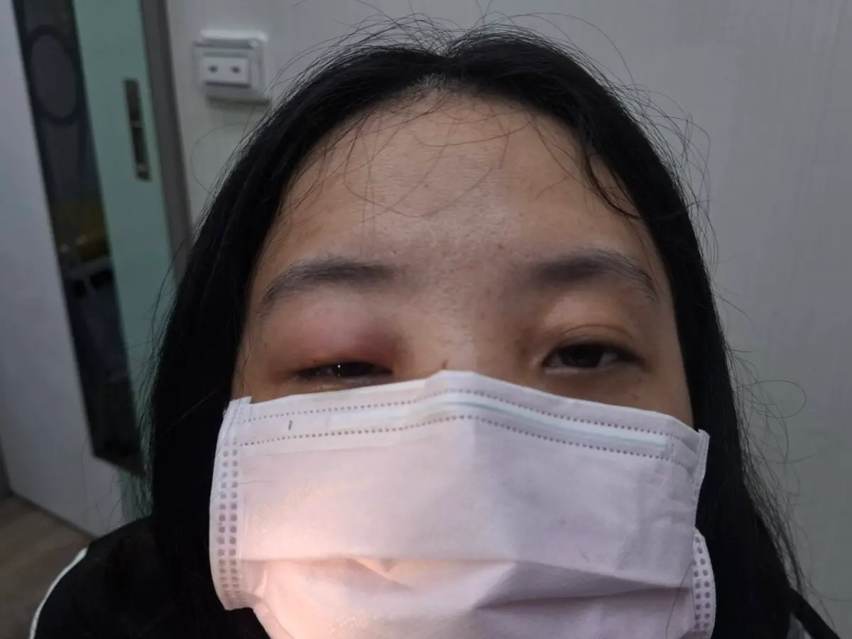 蜜蜂鑽進全罩安全帽 女子眼被螫成蜂窩性組織炎