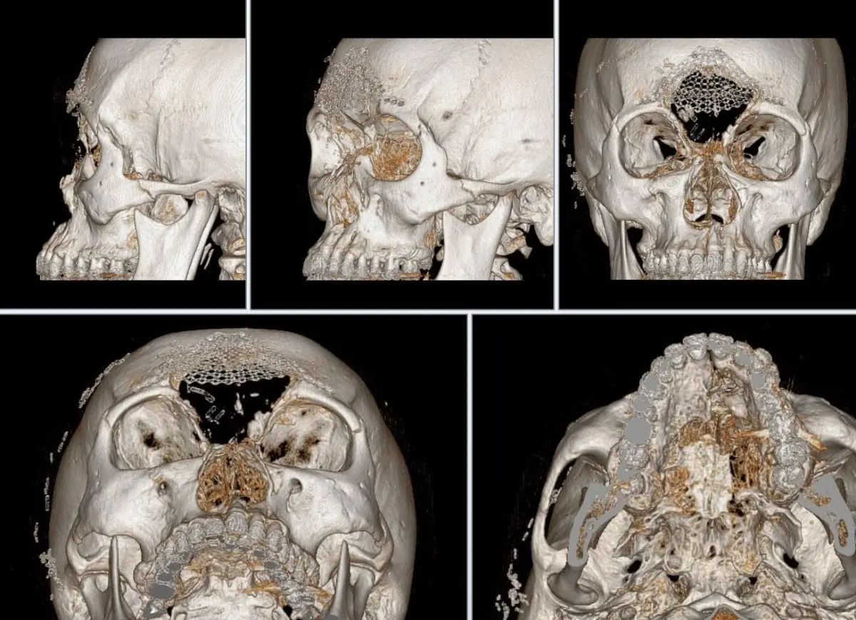 男T91槍傷「臉骨粉碎」！腦部直接暴露 醫3D列印手術重建整張臉
