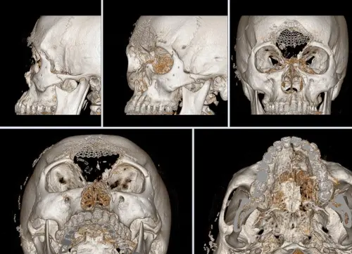 男T91槍傷「臉骨粉碎」！腦部直接暴露　醫3D列印手術重建整張臉
