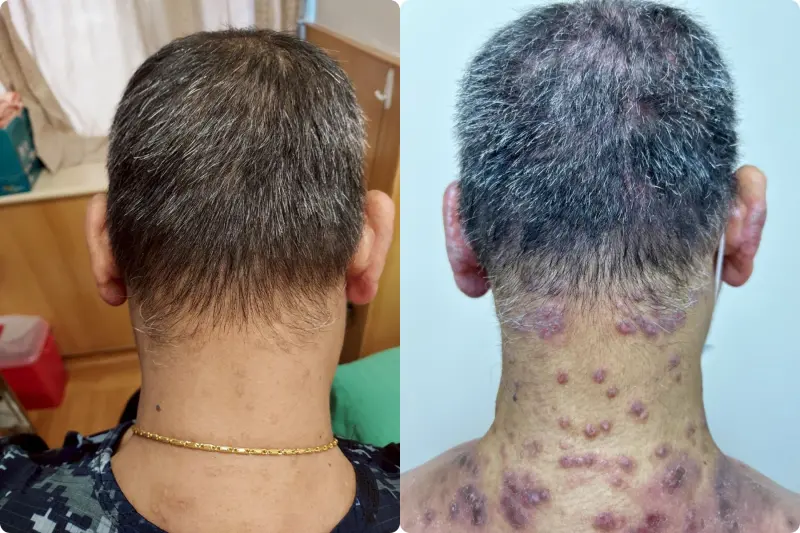 男「全身布滿丘疹」癢到睡不著！醫1方法改善　全台逾29萬人罹病