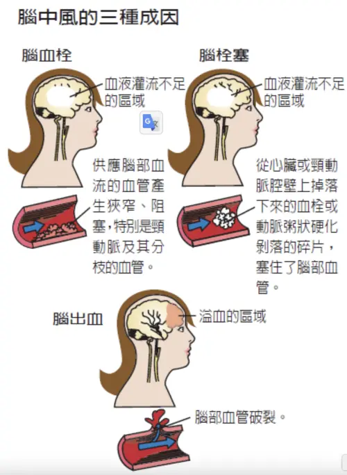 ▲腦中風三種成因。（圖／翻攝衛福部）