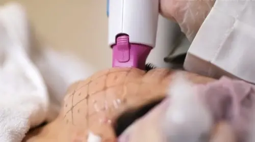 ▲鳳凰電波採單極電波技術、搭載 3D 立體容積式加熱，加上專利 AccuREP® 智慧能量優化系統，使每發能量都更均勻穩定。（圖／鳳凰電波提供）