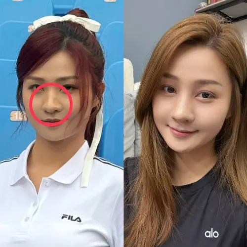 ▲小紫二月拍攝廣告時，發現鼻樑「整個變 S 型」，醫師提醒鼻腔內部受傷情況相當嚴重，「時間再更長得話，後面會壓迫到影響呼吸」。（圖／樂天桃猿提供）