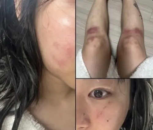 ▲Jvcki Wai在社群曬出自己全身都是傷的照片，指控前男友家暴。（圖／@jvckiwai IG）