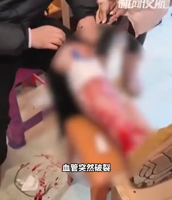 ▲中國哈爾濱日前有一名湖南遊客，在攝氏零下20度的天氣僅穿單薄長褲，小腿靜脈曲張血管破裂，噴出大量鮮血。（圖／翻攝自微博）