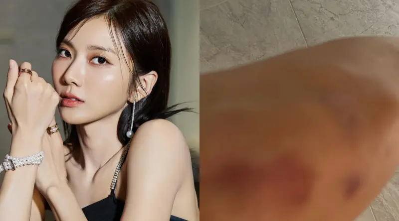 ▲「豆花妹」蔡黃汝在IG透露被坦克車撞，同時曝光大片瘀青照，引起粉絲關心。稍早經紀人回應傷勢，透露文中的坦克車，其實是許孟哲本人。（圖／豆花妹FB）