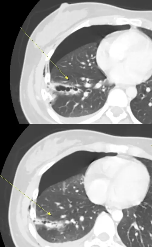 ▲醫學影像檢查圖，兩節斷裂肋骨插入肺組織，造成肺臟破裂。（圖／澄清醫院提供）