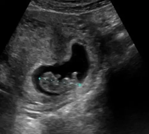 ▲元老級電競實況女神懷孕了！蝴蝶兒聖誕節突拋喜訊　甜曬超音波照（圖／蝴蝶兒IG@butterfu.u）