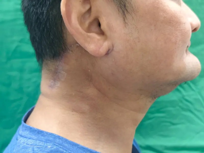 男子口腔潰瘍逾兩週未癒合　一查發現是口腔癌二期