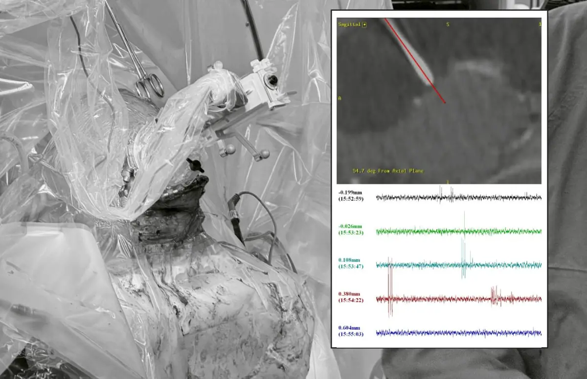 ▲對於藥物難治型癲癇個案，台大醫院團隊完成「首例最新型深腦刺激系統」植入。（圖／台大醫院提供）