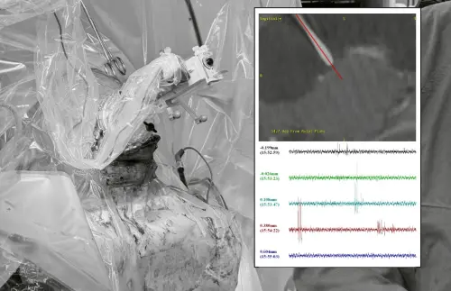 20歲男「藥物難治型癲癇」求醫10年沒效　台大首例最新型手術緩解
