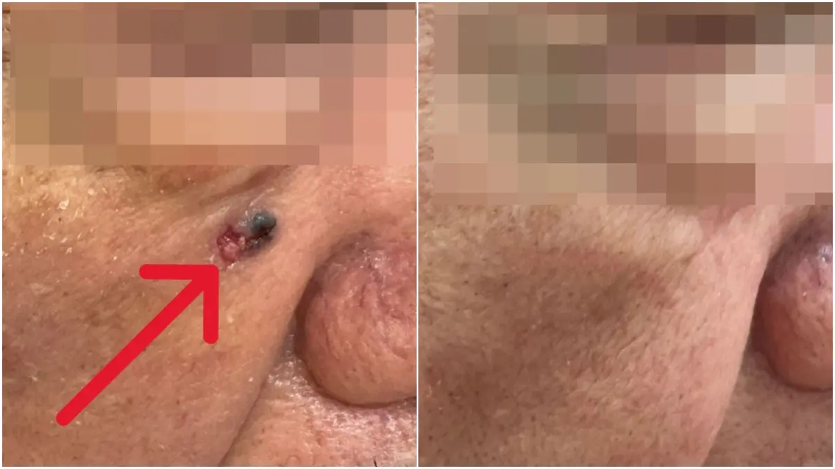 ▲個案右臉出現黑色斑塊（左），切片檢驗確診為基底細胞癌，隨即接受皮膚腫瘤廣泛性切除手術，術後恢復良好。（圖／台北慈濟醫院提供）