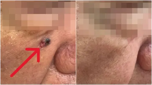 男臉冒「小斑塊」以為痣！就醫揪出癌　醫揭1行為風險高
