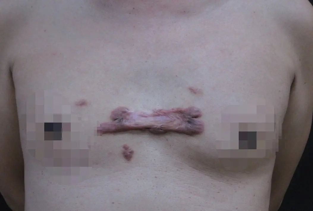 ▲20歲的男性弄破胸前青春痘，變成長10多公分、寬4、5公分，俗稱「蟹足腫」 的疤痕。（圖／員榮醫院提供）