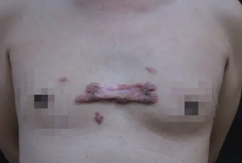 20多歲男胸部有青春痘！擠破竟長出「大蜈蚣」　醫揭原因
