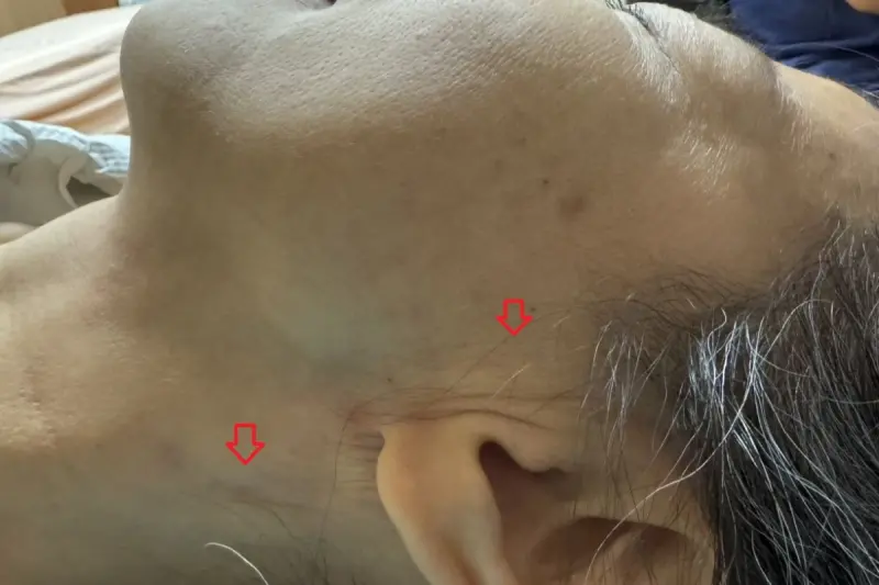 ▲婦人臉部突然出現腫塊，檢查是罕見腮腺癌，影響臉部外觀 。（圖／台北慈濟醫院提供）