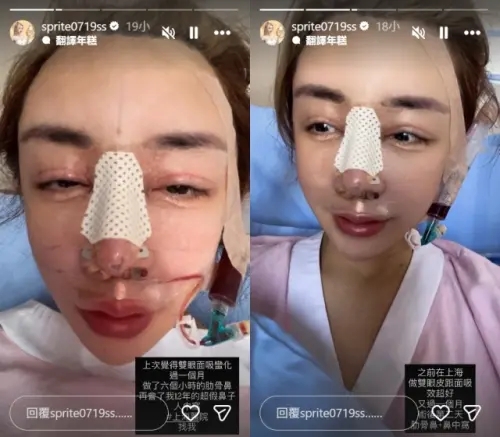 ▲雪碧公開做完整形手術的術後照。（圖／雪碧IG@sprite0719ss）