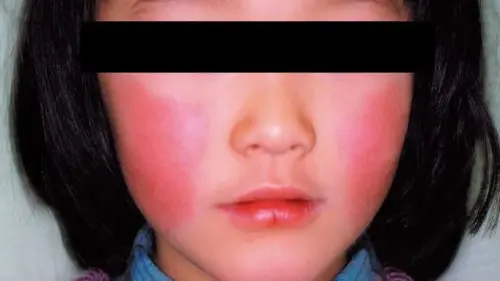 11歲女童大叫一聲後猝死！體內驗出「B19病毒」：症狀就像感冒
