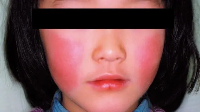 11歲女童大叫一聲後猝死！體內驗出「B19病毒」：症狀就像感冒