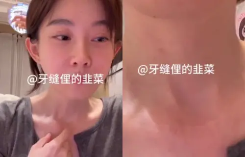 ▲馮提莫開直播大方曬甲狀腺癌手術的疤痕。（圖／微博@牙縫裡的韭菜）