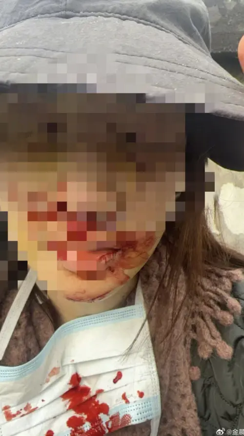 ▲金晨曬出事故當下滿臉都是血的照片。（圖／金晨 微博）