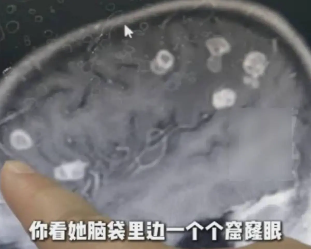 ▲中國河南有名6歲女童，在協助家人清掃老家後，連續高燒17日，送到醫院才發現腦部出現20餘個坑洞。（圖／翻攝自微博）