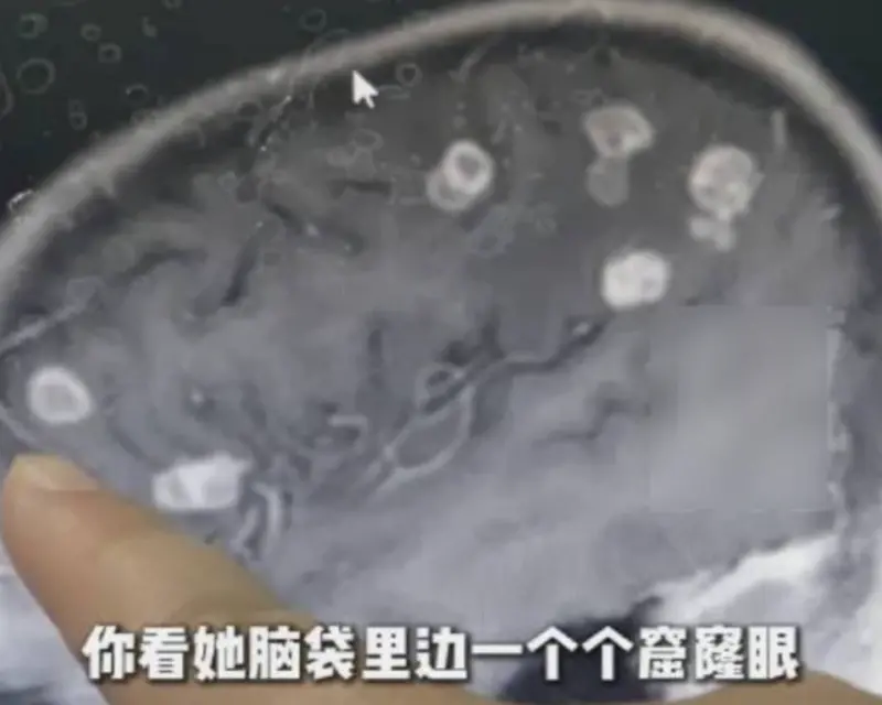 ▲中國河南有名6歲女童，在協助家人清掃老家後，連續高燒17日，送到醫院才發現腦部出現20餘個坑洞。（圖／翻攝自微博）