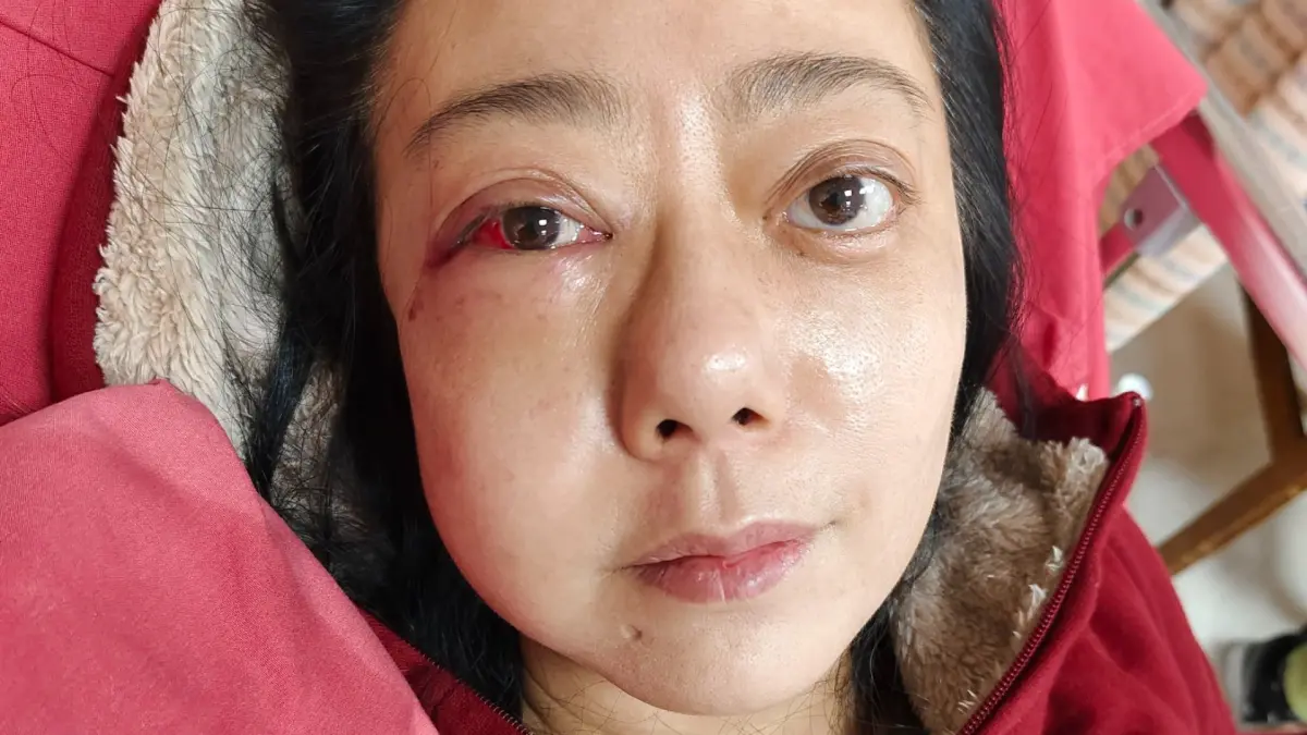 ▲高慧君去年在家中突然昏倒，臉撞地板造成3處骨折，蘋果肌也永遠消失。（圖／經紀人提供）