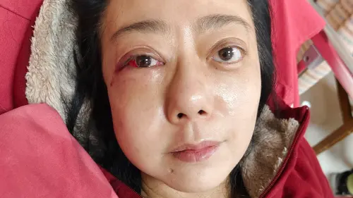 高慧君家中突然昏倒！臉猛撞地板3處骨折　蘋果肌永遠消失不見
