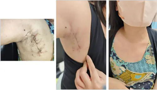 ▲劉紹正提到，包括在意疤痕位置的患者、在意聲音品質、恢復速度者皆對於相關手術頗有關心。（圖／三總提供）