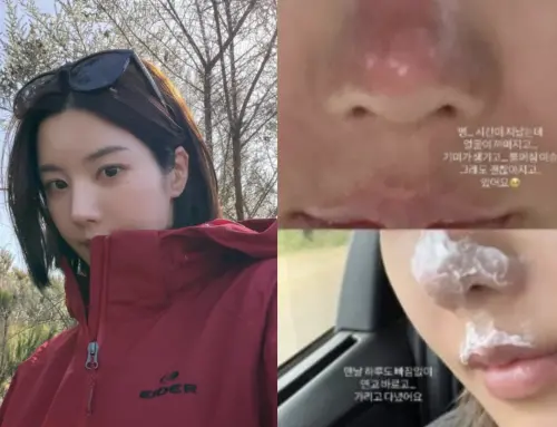 ▲權恩妃灼傷近照看起來很嚴重。（圖／翻攝自IG@silver_rain.__）